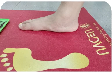Bàn chân bẹt/ sụp vòm/vòm cao